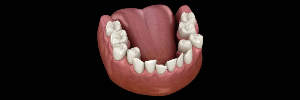 Apiñamiento dental: ¿Cómo corregir los dientes montados?