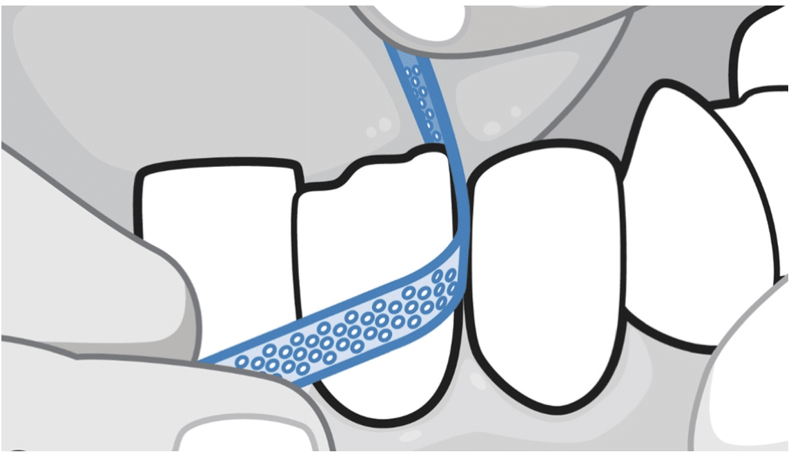 Stripping dental o IPR en ortodoncia: qué es