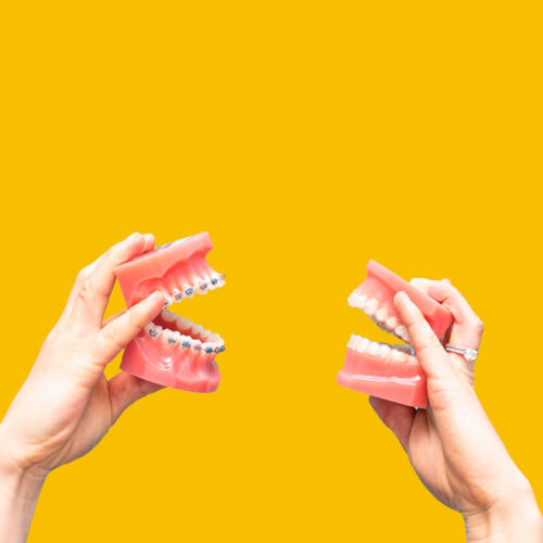 Invisalign vs Brackets: Diferencias, ¿qué es mejor?