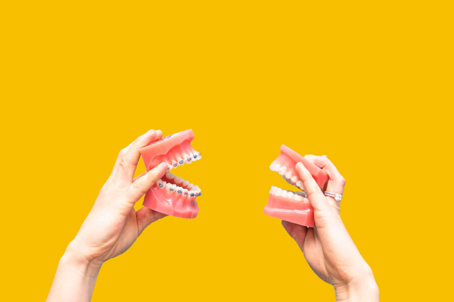 Invisalign vs Brackets: Diferencias, ¿qué es mejor?