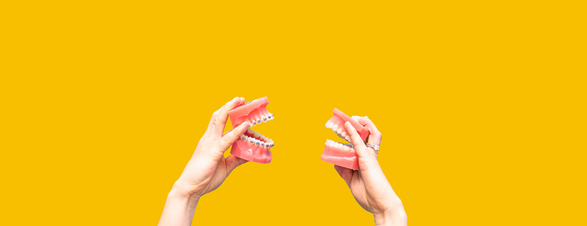 Invisalign vs Brackets, diferencias, ¿qué es mejor?