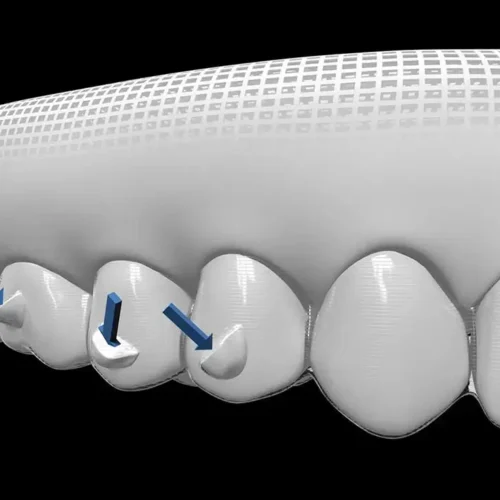 Ataches Invisalign