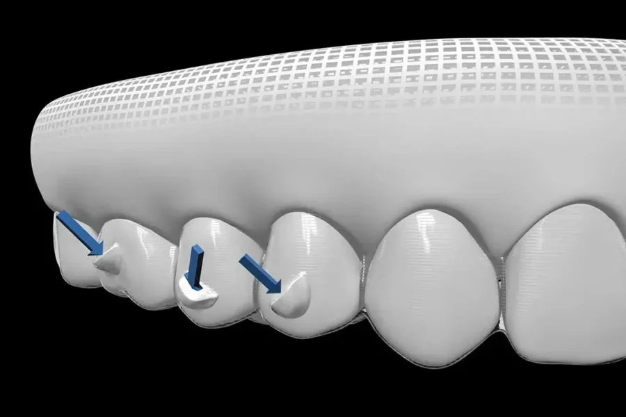 Ataches Invisalign