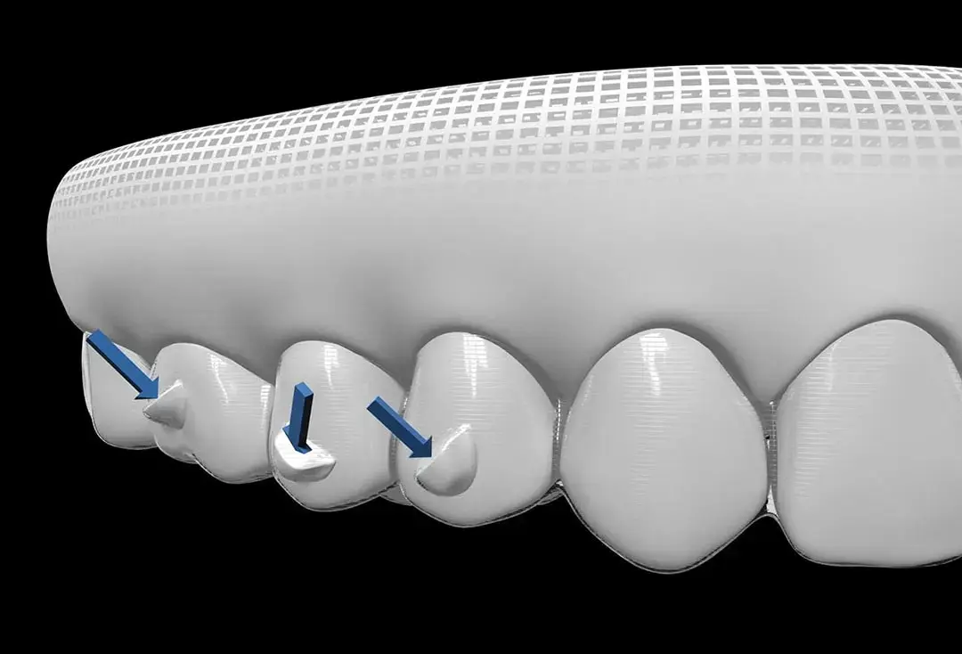 Ataches dentales para ortodoncia invisible, ¿qué son? ¿para qué sirven?