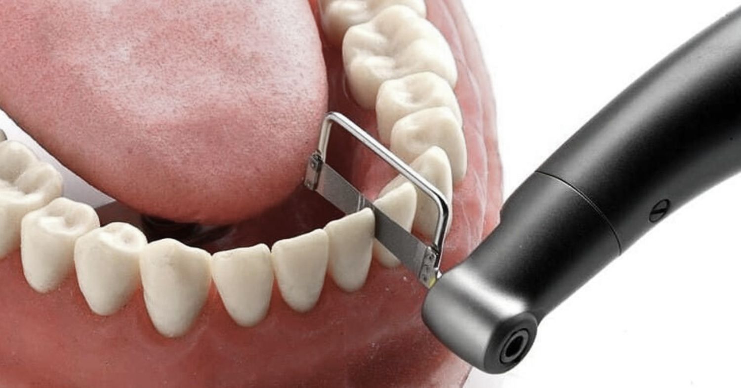 Stripping en Invisalign
