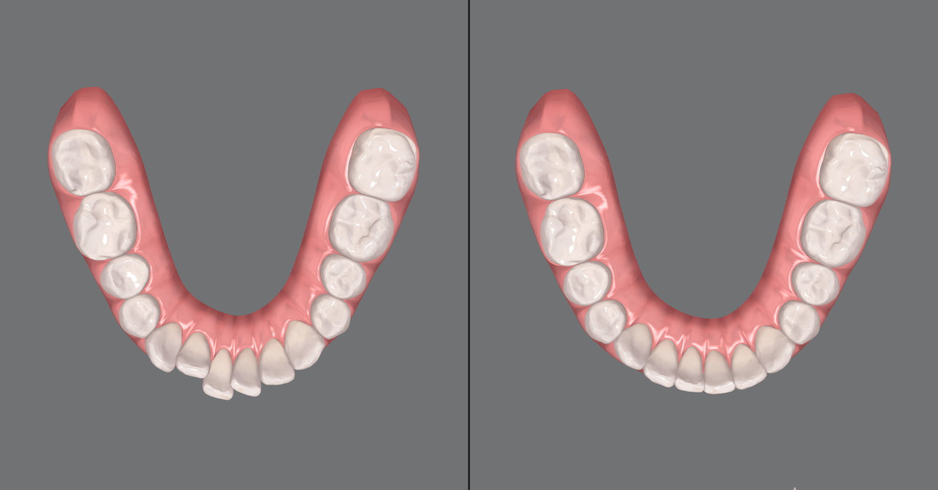Refinamiento de Invisalign: qué es, cuándo se necesita y en qué tratamientos está incluido