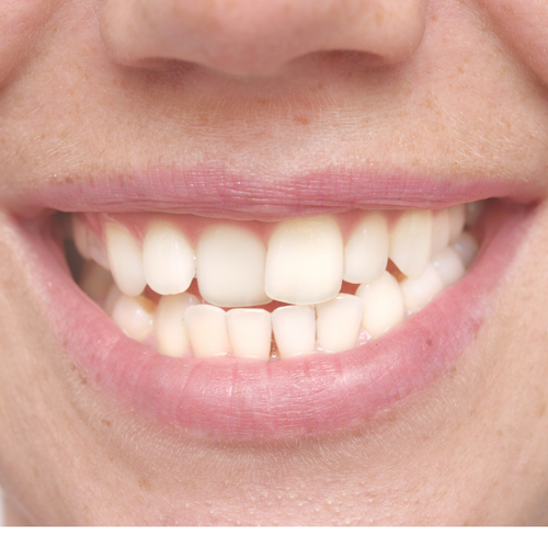 dientes movidos despues de ortodoncia