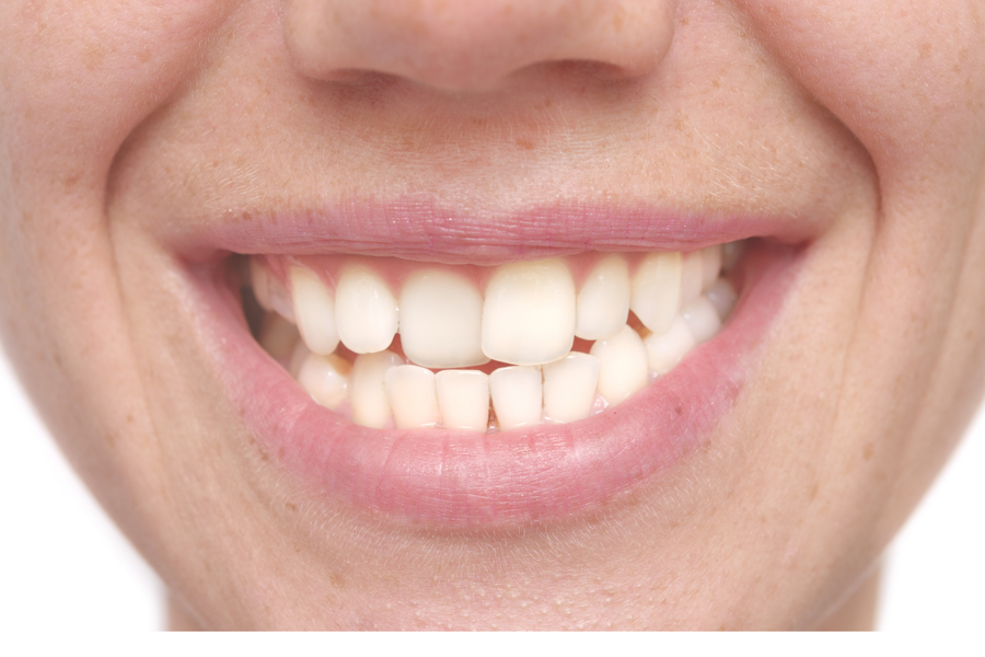 dientes movidos despues de ortodoncia