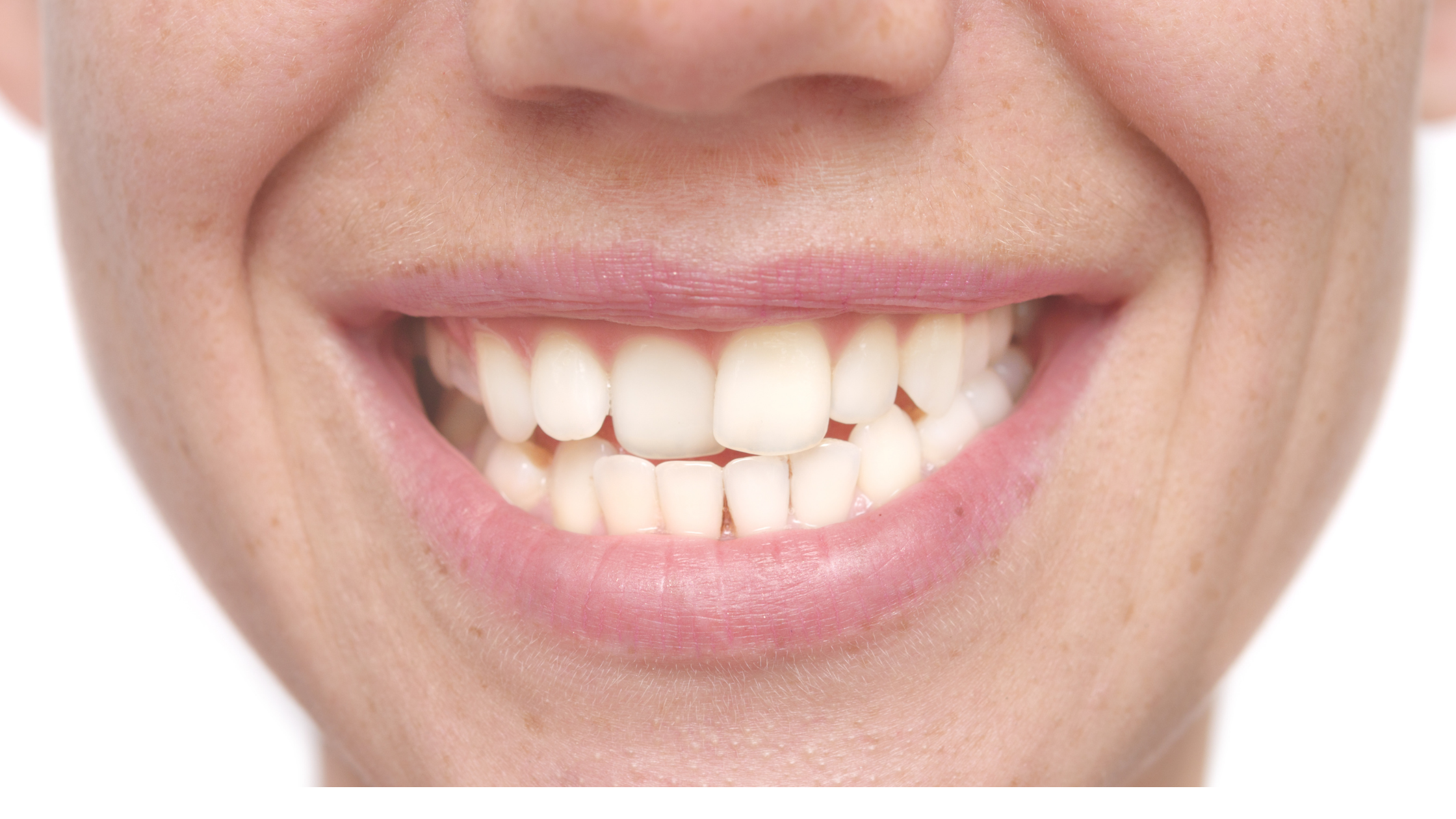 ¿Por qué se vuelven a mover los dientes después de haber llevado ortodoncia?